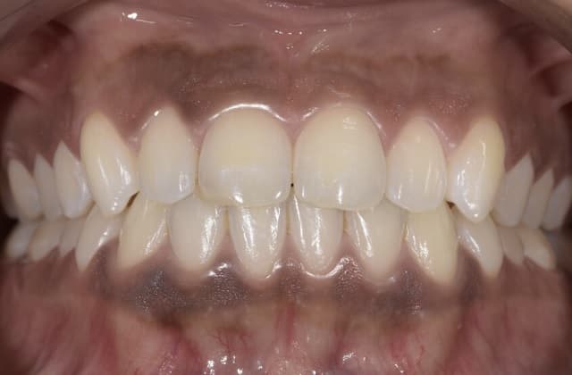 Halte à la dépigmentation des dents !