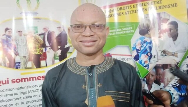 Togo/fin du projet « Droits et Bien-être des personnes atteintes d’albinisme » : plusieurs activités menées